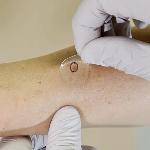 Test for Potential Skin Cancer Malignancy With Out a Scar