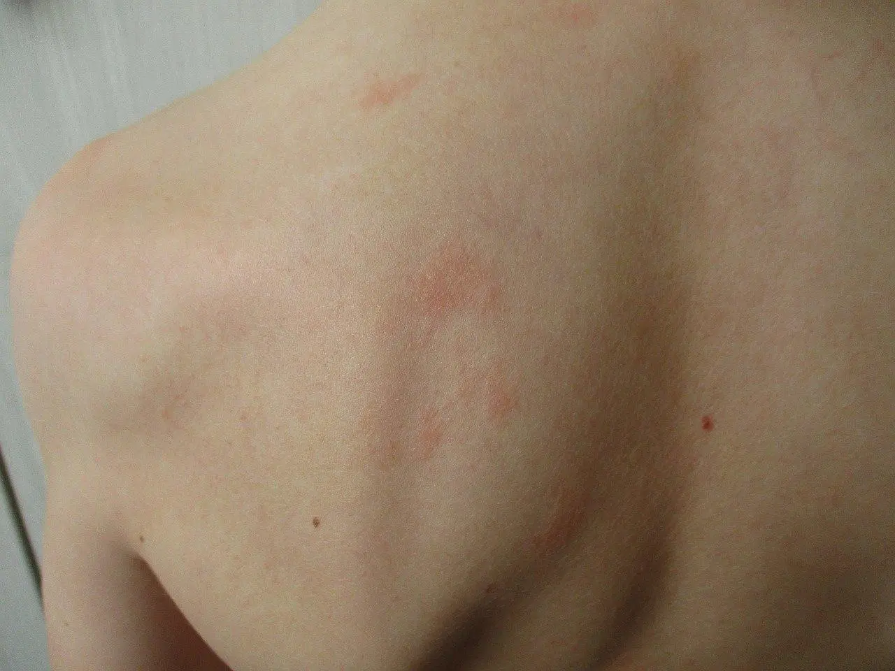 Managing Eczema Eczema on the back