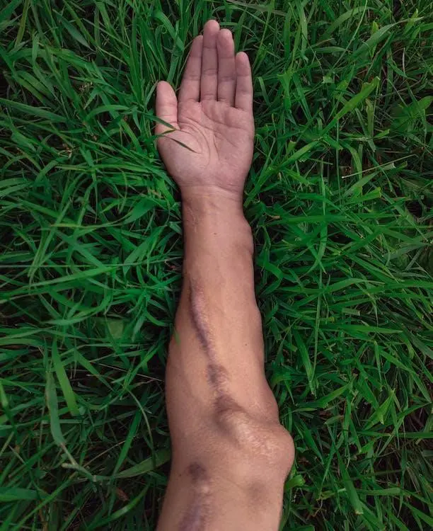 A man’s hand on the grass with a hypertrophic scar