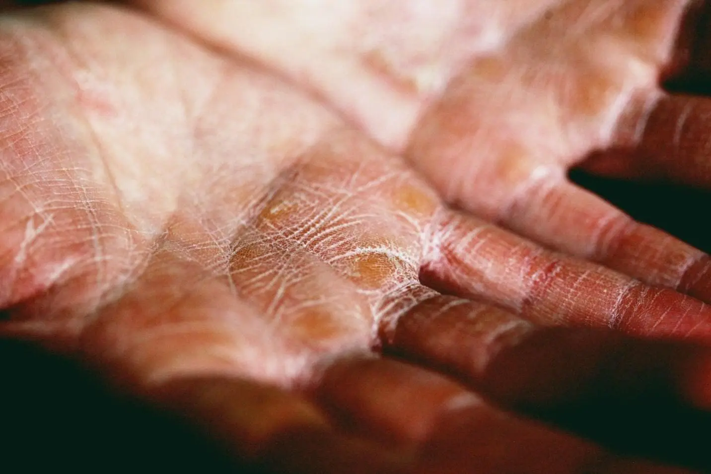 Managing Eczema tips Atopic Eczema