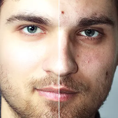 Before,And,After,Cosmetic,Operation.,Young,Man,Portrait,,Isolated,On Florida Dermatologist: Cosmetic, Pediatric & Medical | Suncoast Skin