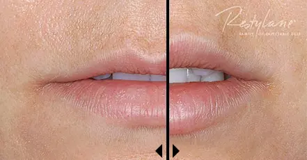 Cosmetic Dermal Fillers: See Restylane Before and After Photos