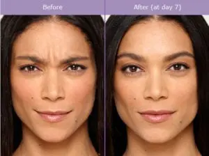 Botox Injection Before And After Photos | Brandon Dermatology | Daytona