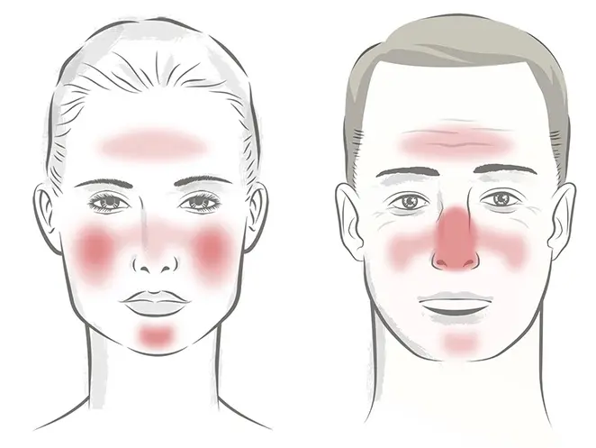 what gets rid of rosacea bumps