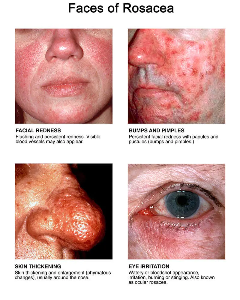 most effective treatment for rosacea