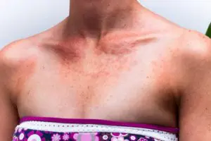 sunburnt skin with allergic reaction