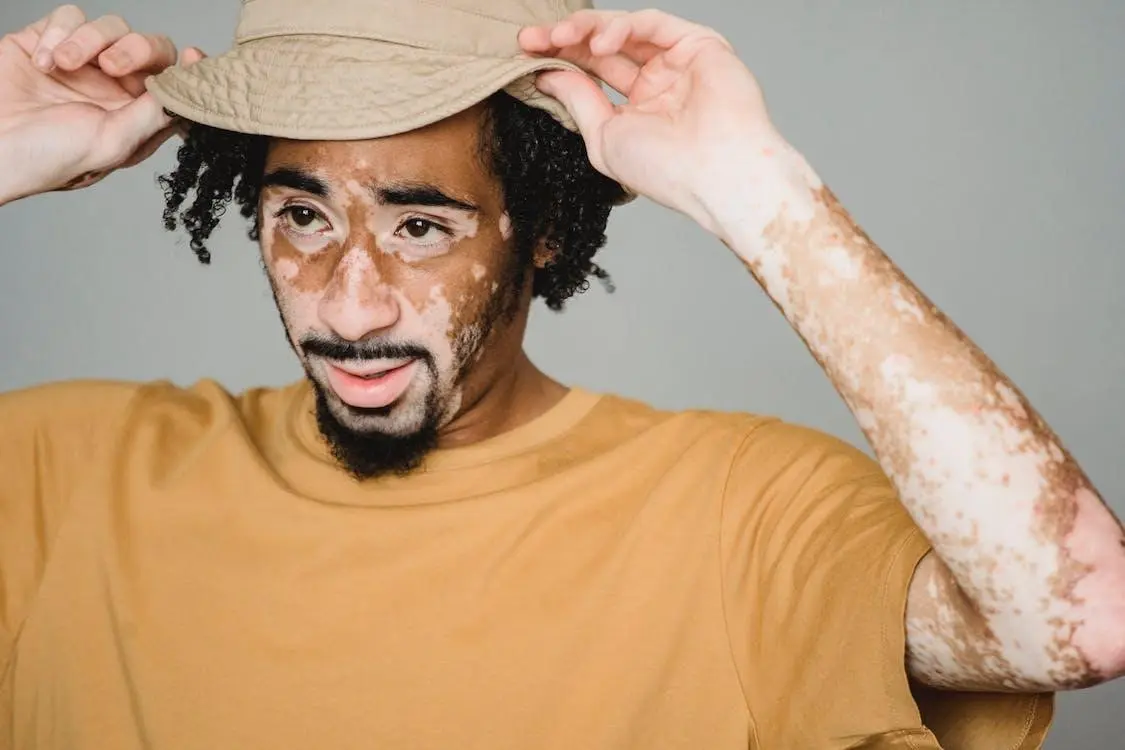 virtiligo a skin disorder