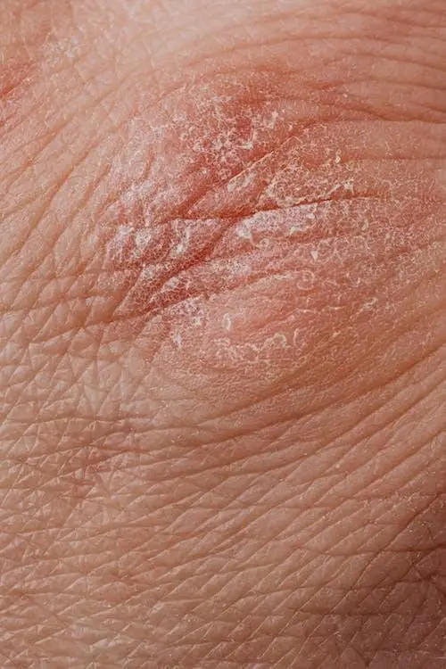 Skin eczema
