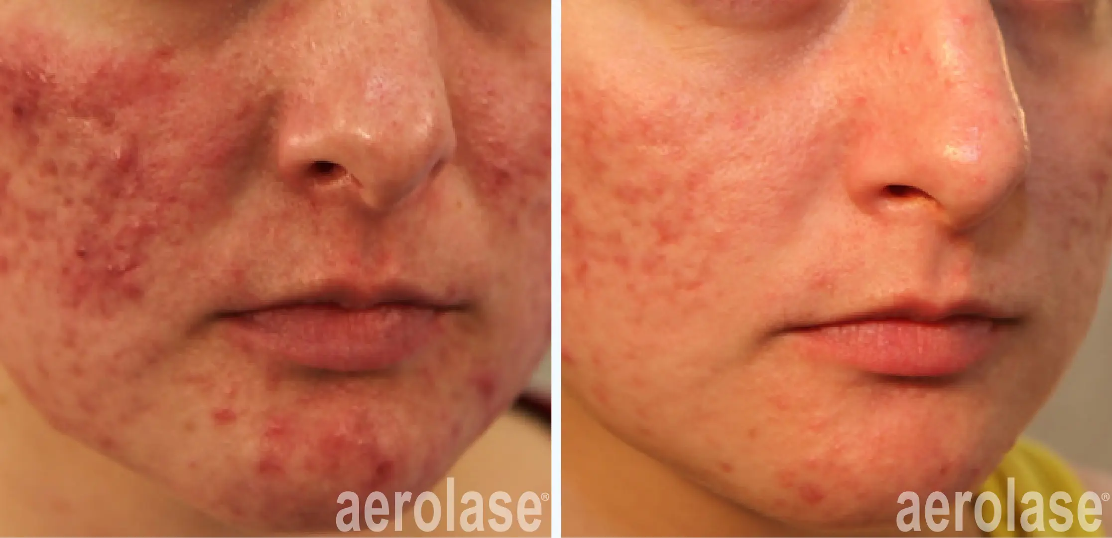 111acne-acne-redness-natalia-geraskova-before-and-after