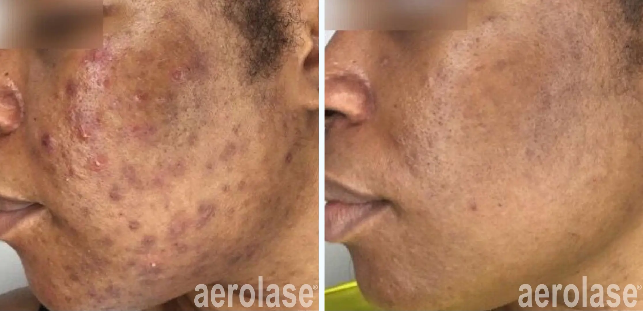 111acne-cheeks-sholema-skinofcolor-before-and-after-1