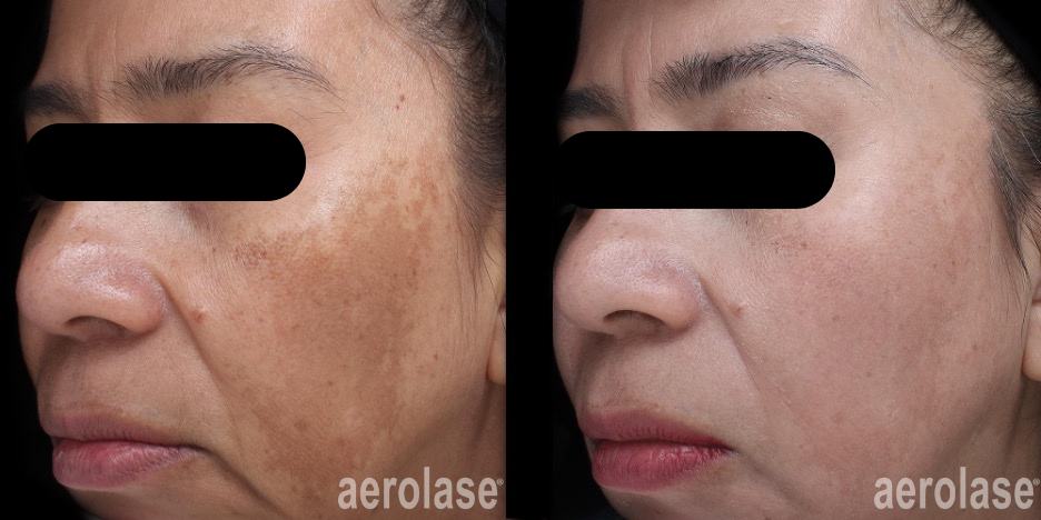 Melasma - jason emer, MD