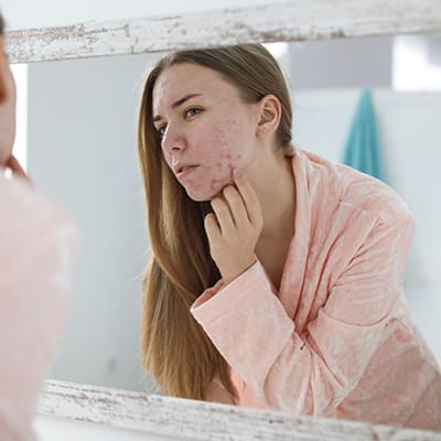 Young,Woman,With,Acne,Problem,Near,Mirror,In,Bathroom Florida Medical Acne Treatment: Dermatology Specialists | Suncoast