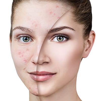 Young,Woman,With,Acne,Before,And,After,Treatment. Florida Medical Acne Treatment: Dermatology Specialists | Suncoast