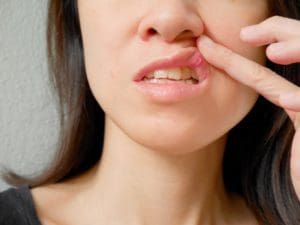 symptom of canker sore