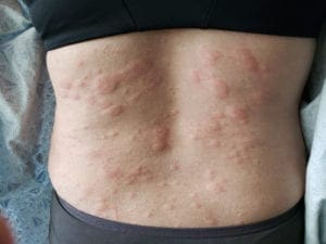 effective hives remedies