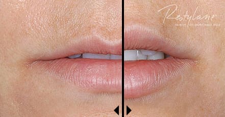 Cosmetic Dermal Fillers: See Restylane Before and After Photos