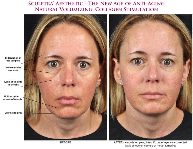 sculptra before and after photos