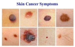 Skin Cancer Test & Treatment – Sarasota, FL Dermatologist