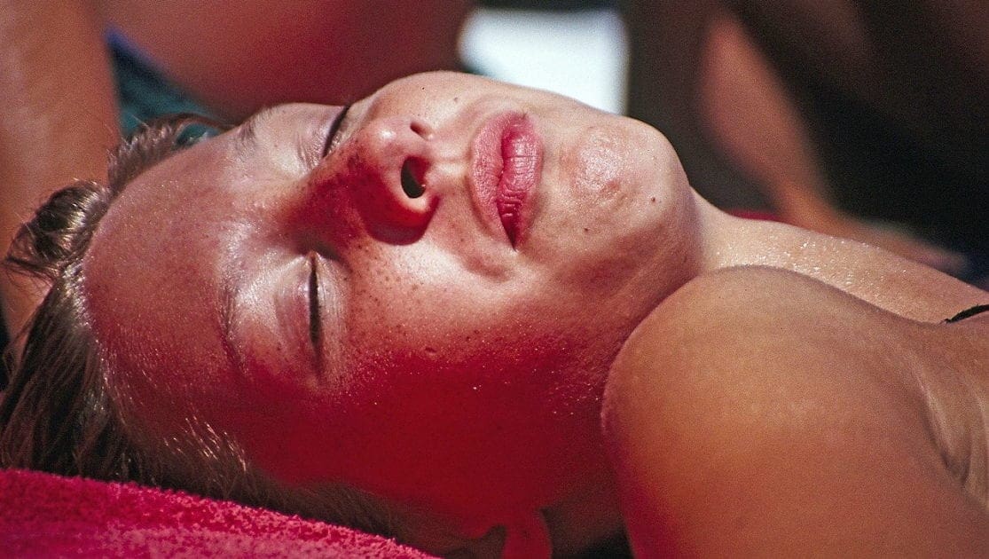 young woman sunburned skin