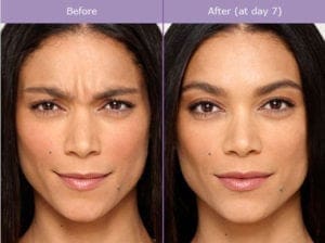 Botox Injection Before And After Photos | Brandon Dermatology | Daytona