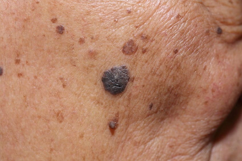 What Skin Cancer Looks Like