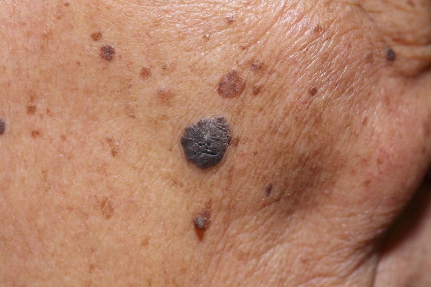 - Suncoast Skin Solutions What Skin Cancer Looks Like