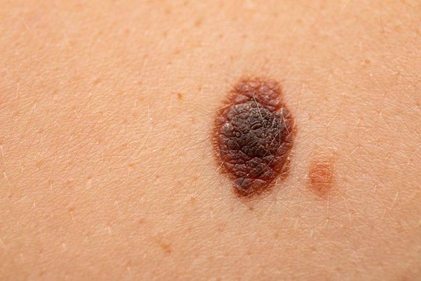 - Suncoast Skin Solutions What Skin Cancer Looks Like