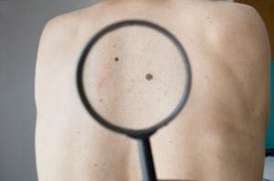 Melanoma is a deadly skin cancer