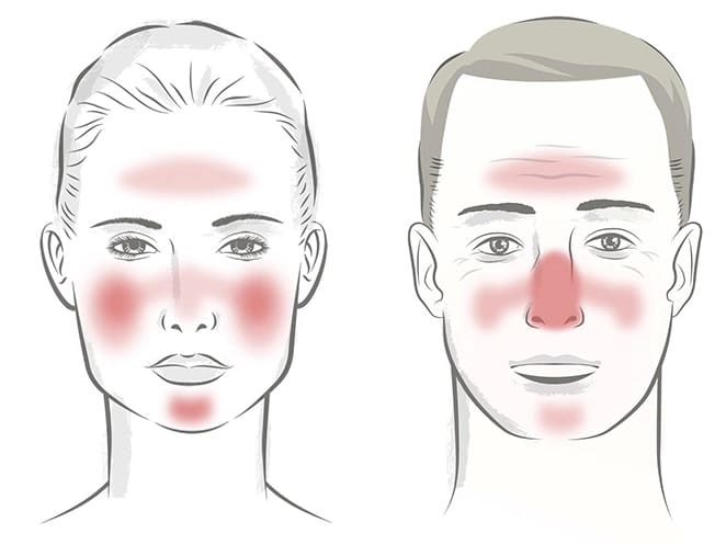 what gets rid of rosacea bumps