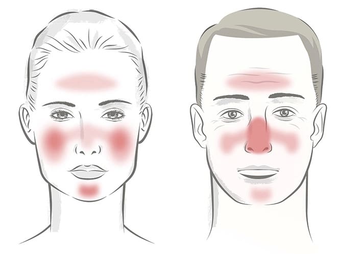 Delaware Rosacea Treatment