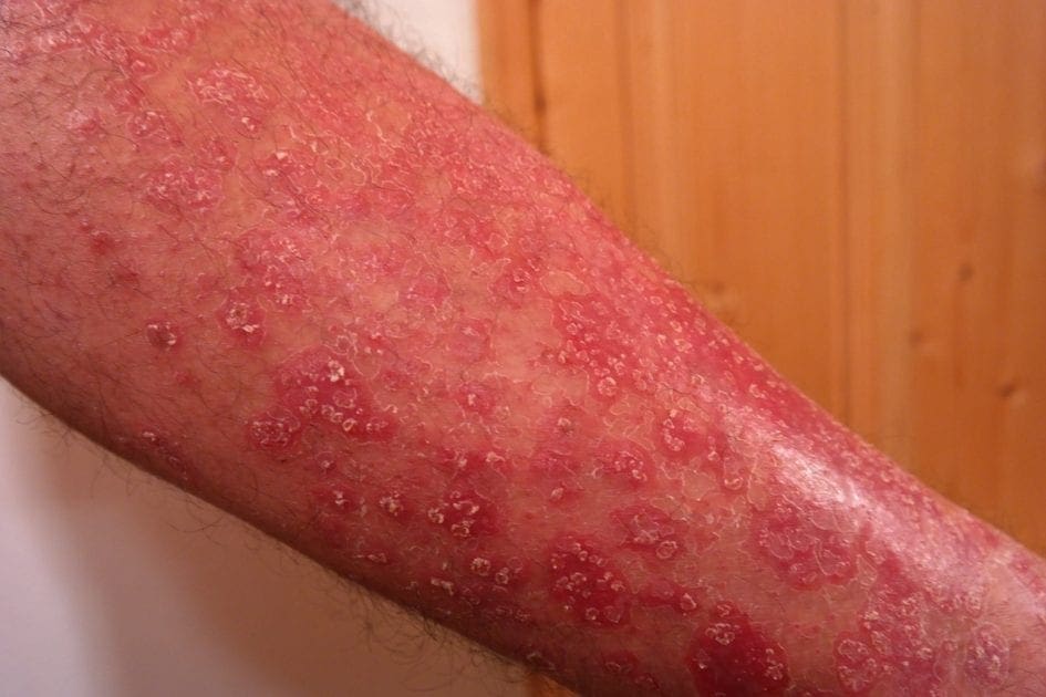 What Causes Psoriasis – Is it Contagious