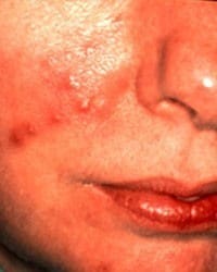 rosacea symptoms on the face