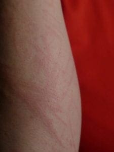 tracks rashes kids arm