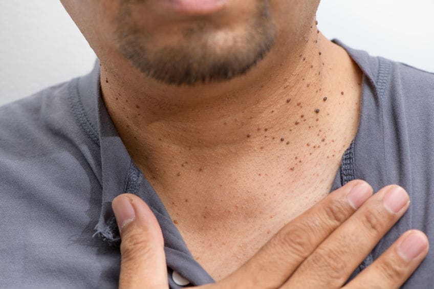 skin tags located in the neck area