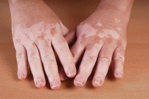 symptoms of vitiligo