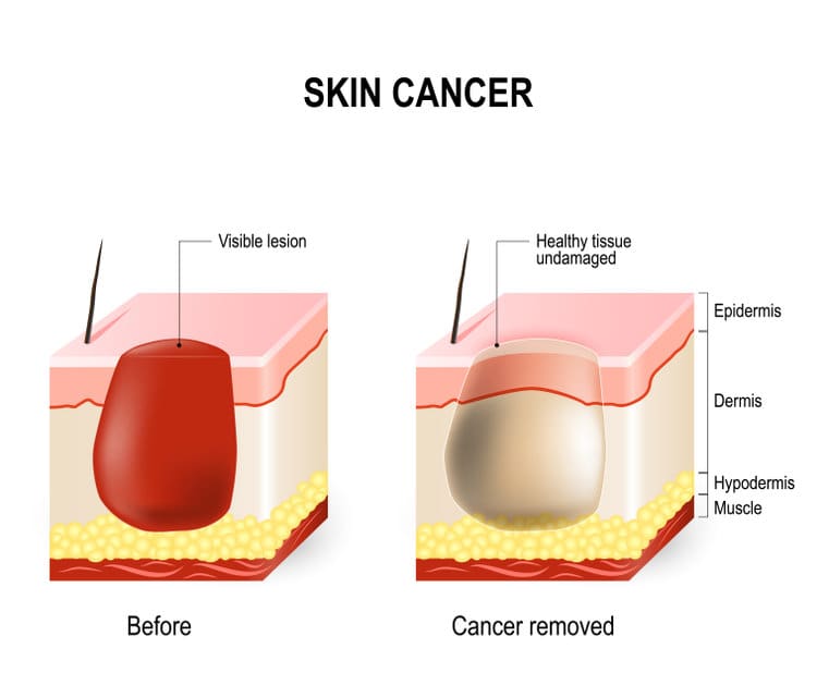 skin cancer removal