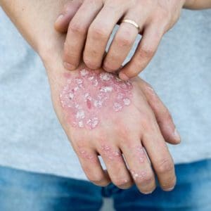 Psoriasis