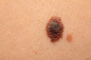 nonmelanoma skin cancer treatments