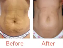 Accent Skin Firming Tampa  Skin Tightening St. Petersburg