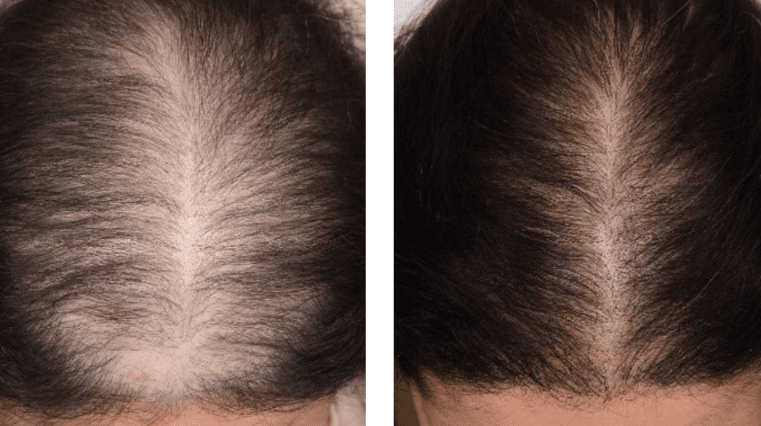 PRP Injections for Hair Loss & Alopecia in Florida - Suncoast Skin Solutions