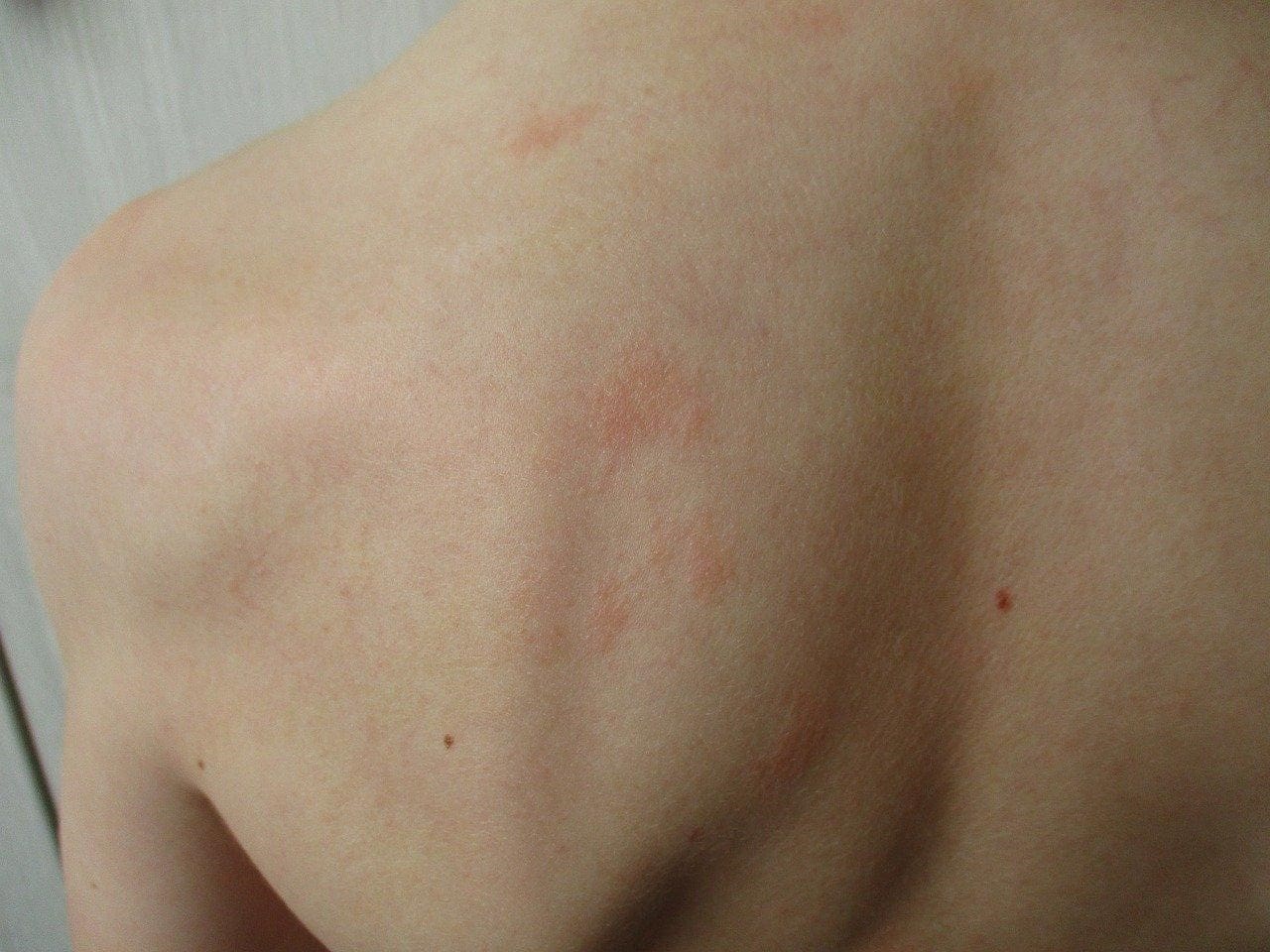 Eczema on the back