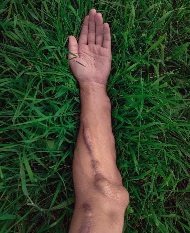 A man’s hand on the grass with a hypertrophic scar