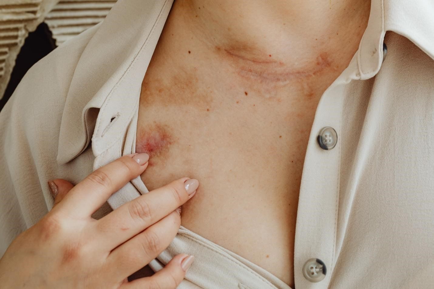 Actinic Keratosis Treatment