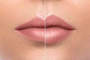 Juvederm Dermal Filler Before & After Photos