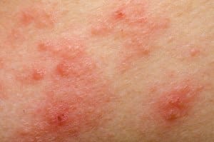 Florida Dermatologist FAQ’s: What Causes Atopic Dermatitis (Eczema)?