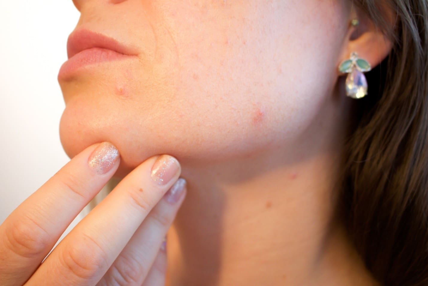 Teenage Skin Problems