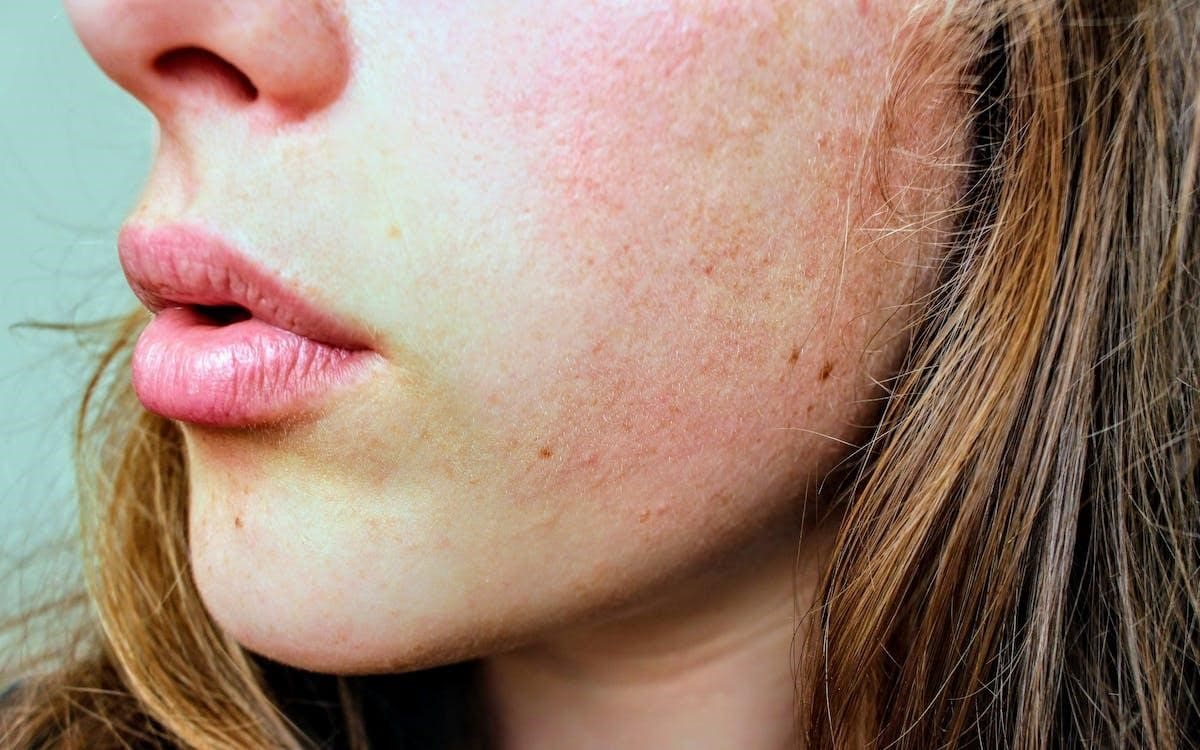 Psoriasis Is it treatable?