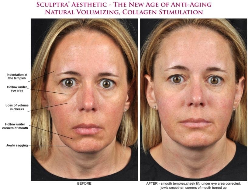 Sculptra Dermal Filler Before & After Photos