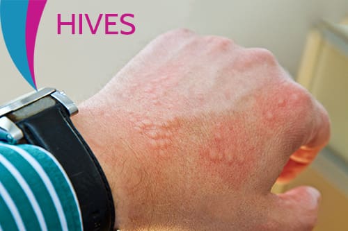 Relief from Hives
