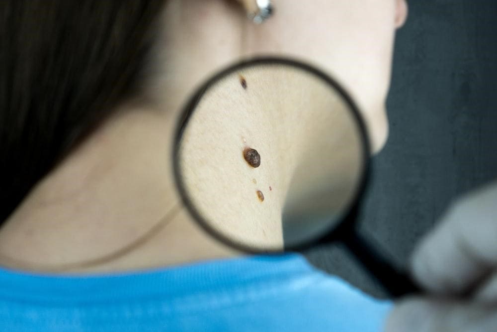 Exploring Skin Cancer: Risk Factors and Early Detection